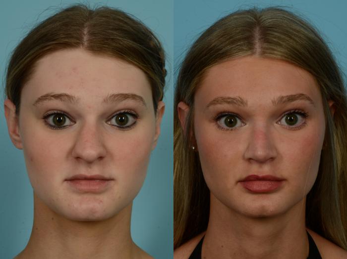 Before & After Rhinoplasty by Dr. Sinno Case 1145 Front View in Chicago, IL