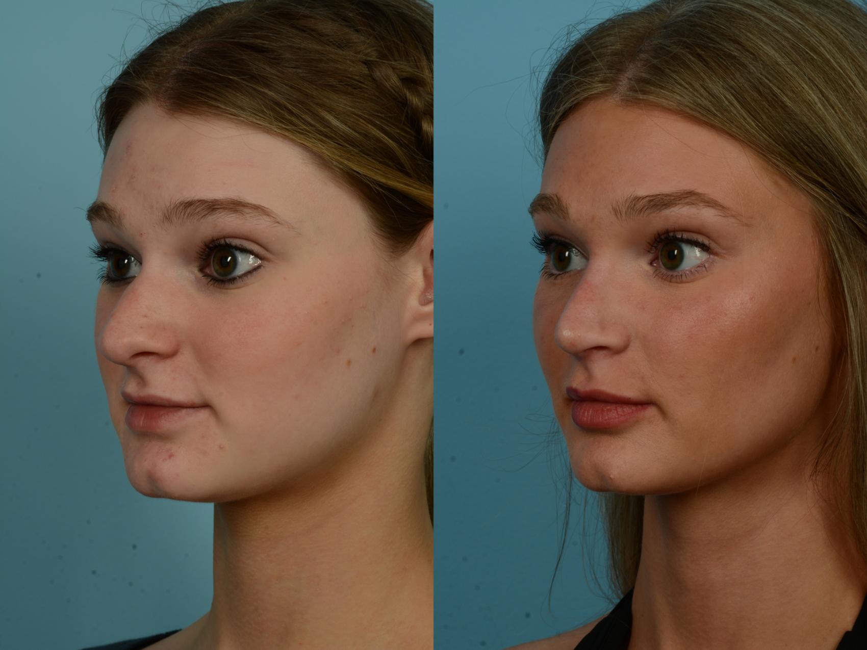 Before & After Rhinoplasty by Dr. Sinno Case 1145 Left Oblique View in Chicago, IL