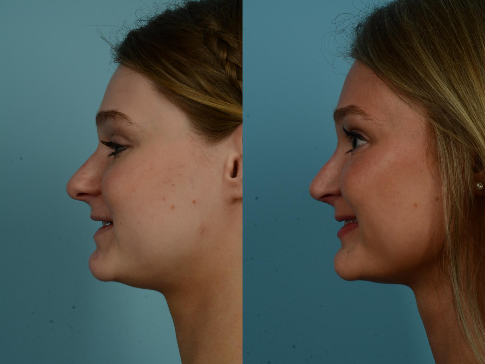 Before & After Rhinoplasty by Dr. Sinno Case 1145 Left Side View in Chicago, IL