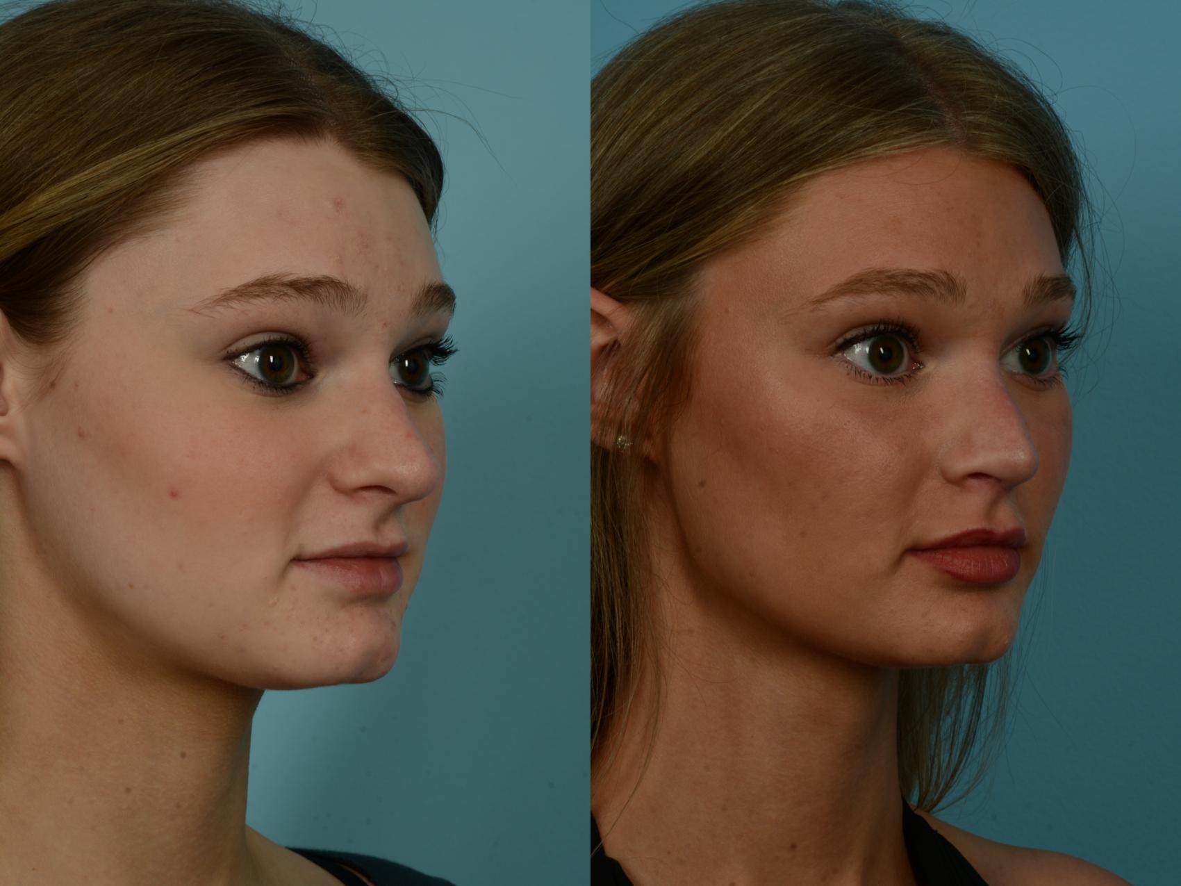 Before & After Rhinoplasty by Dr. Sinno Case 1145 Right Oblique View in Chicago, IL
