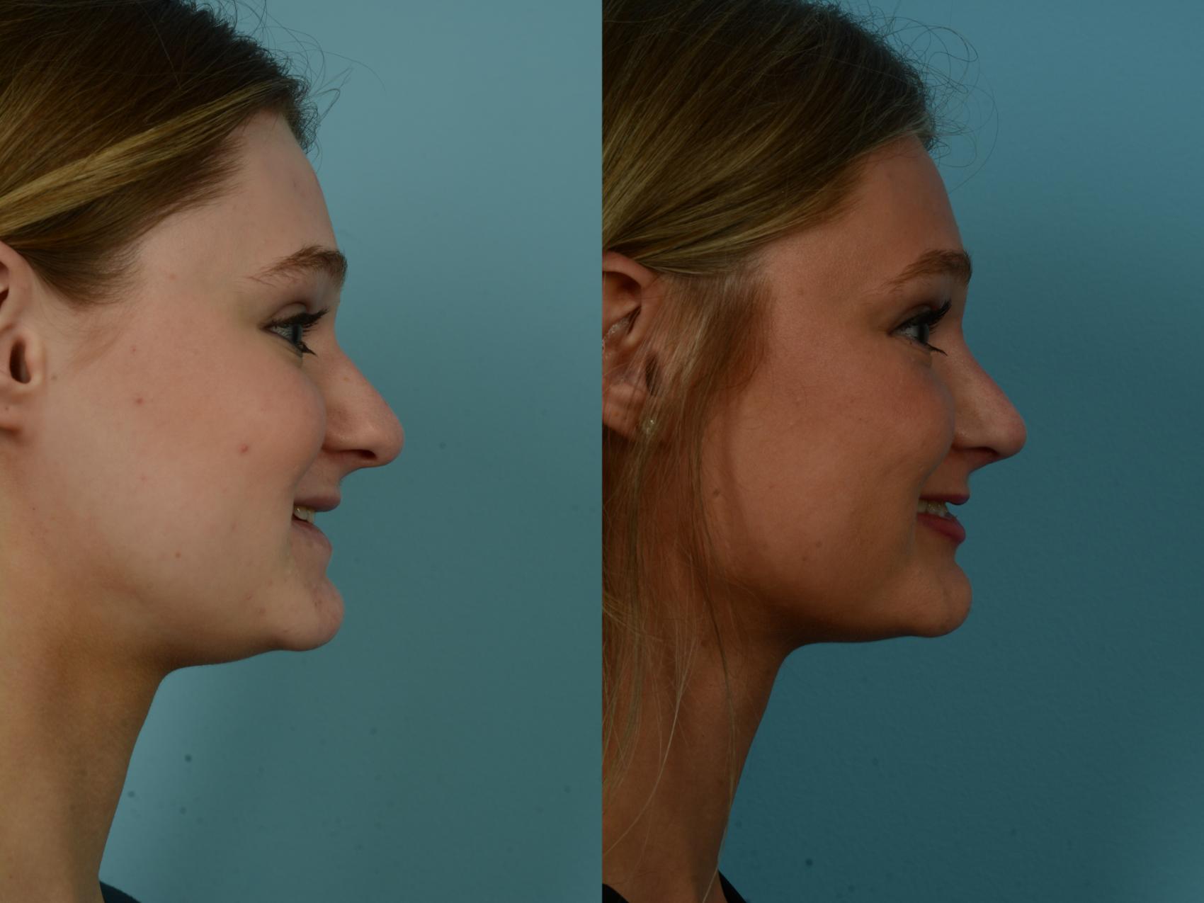 Before & After Rhinoplasty by Dr. Sinno Case 1145 Right Side View in Chicago, IL