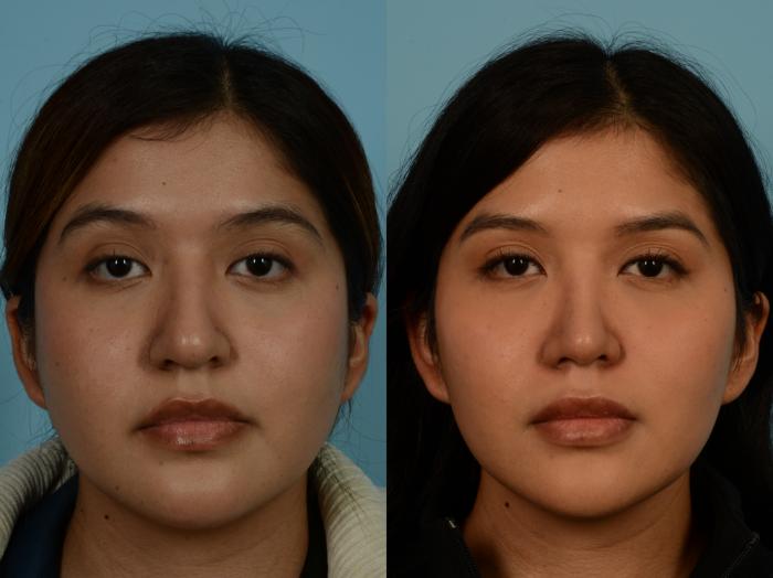 Before & After Rhinoplasty by Dr. Sinno Case 1146 Front View in Chicago, IL