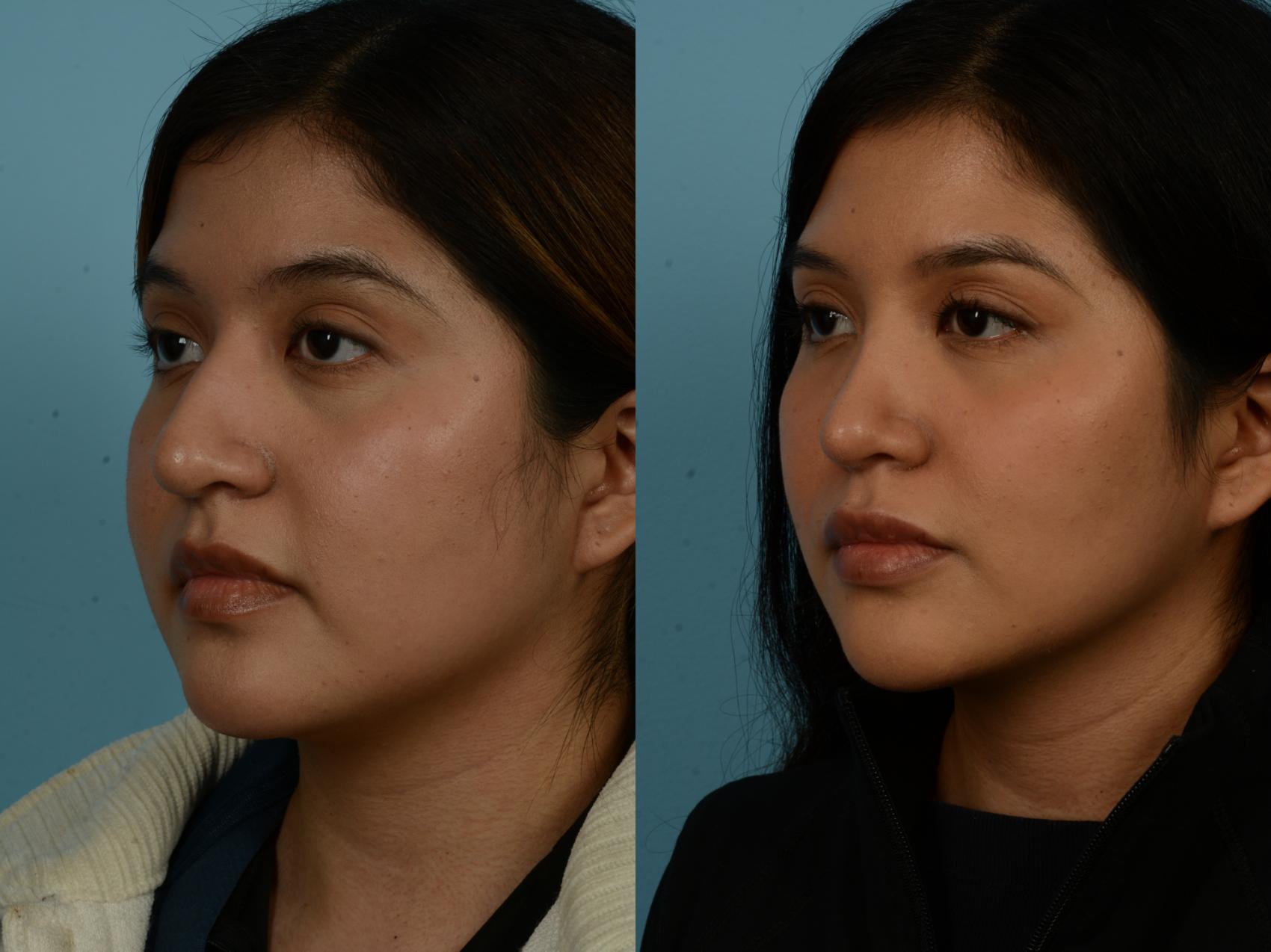 Before & After Rhinoplasty by Dr. Sinno Case 1146 Left Oblique View in Chicago, IL