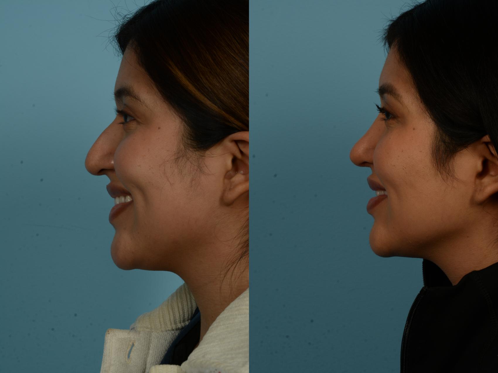Before & After Rhinoplasty by Dr. Sinno Case 1146 Left Side View in Chicago, IL