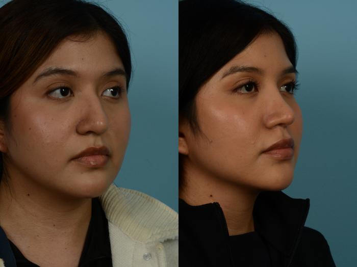 Before & After Rhinoplasty by Dr. Sinno Case 1146 Right Oblique View in Chicago, IL
