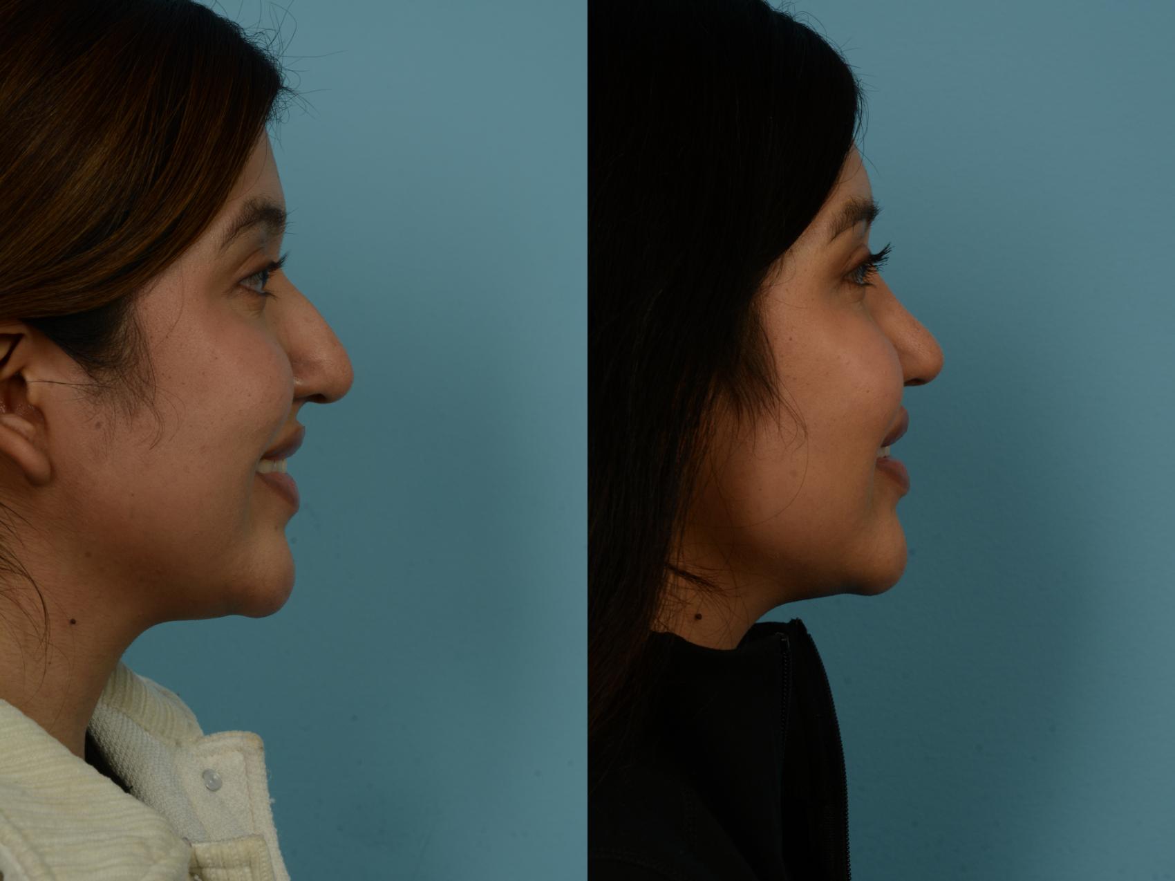 Before & After Rhinoplasty by Dr. Sinno Case 1146 Right Side View in Chicago, IL