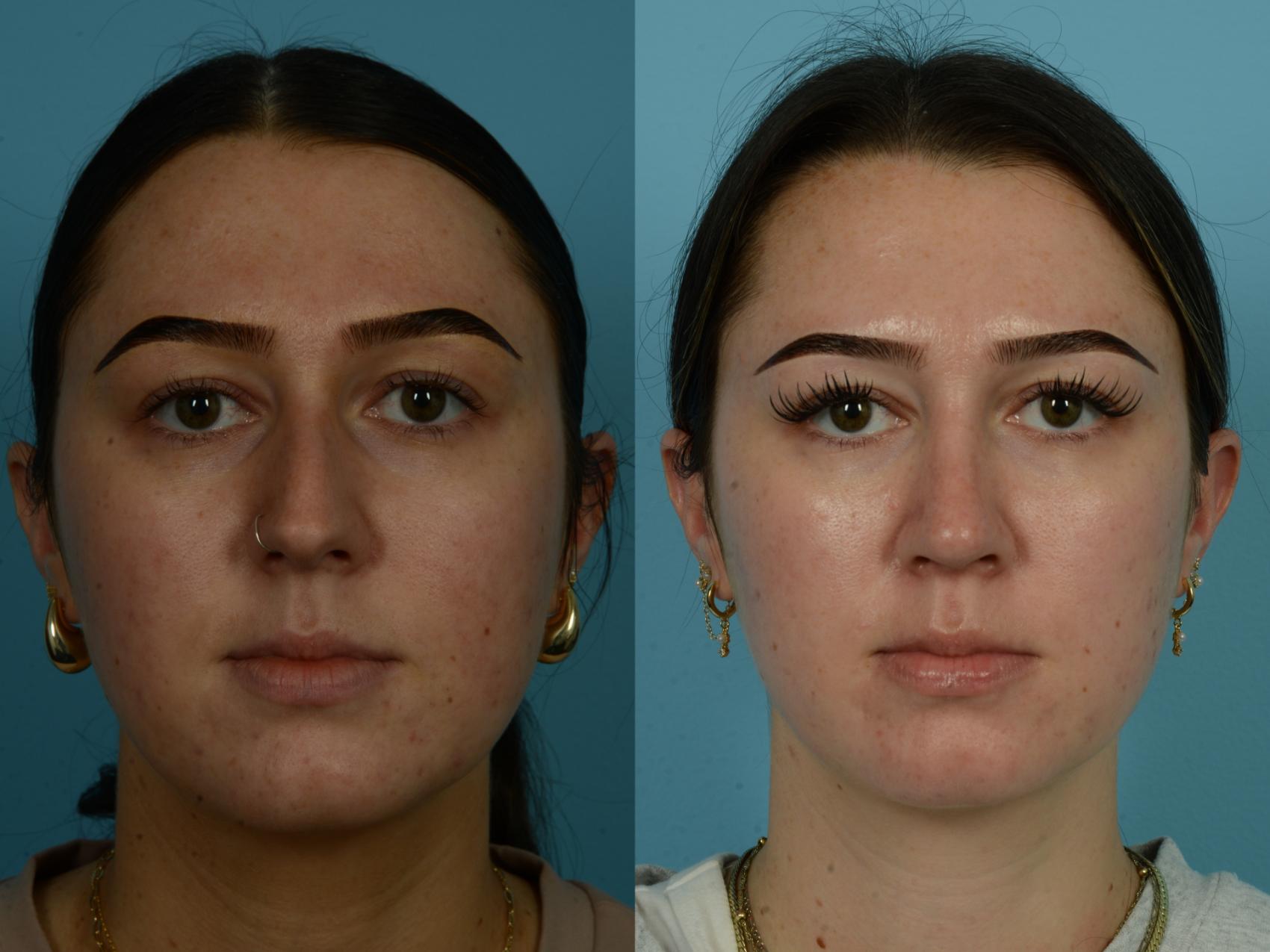 Before & After Rhinoplasty by Dr. Sinno Case 1147 Front View in Chicago, IL