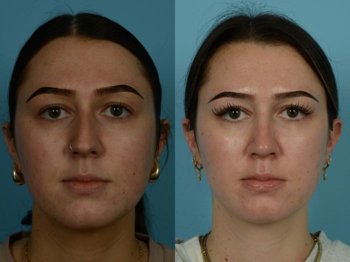 Before & After Rhinoplasty by Dr. Sinno Case 1147 Front View in Chicago, IL