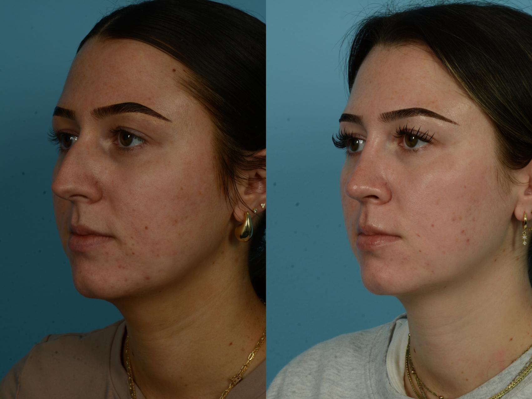 Before & After Rhinoplasty by Dr. Sinno Case 1147 Left Oblique View in Chicago, IL