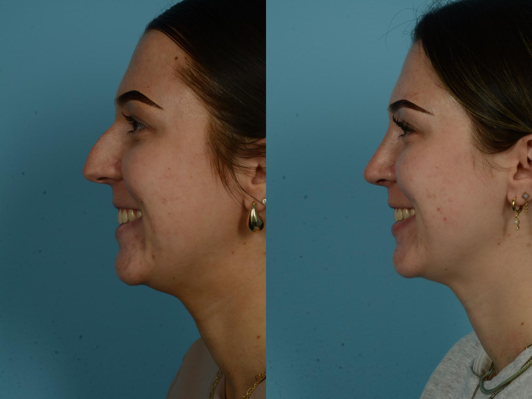 Before & After Rhinoplasty by Dr. Sinno Case 1147 Left Side View in Chicago, IL