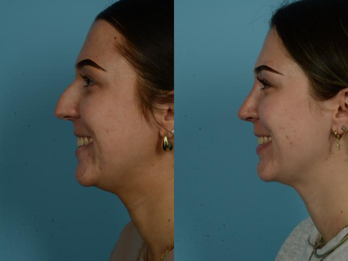 Before & After Rhinoplasty by Dr. Sinno Case 1147 Left Side View in Chicago, IL