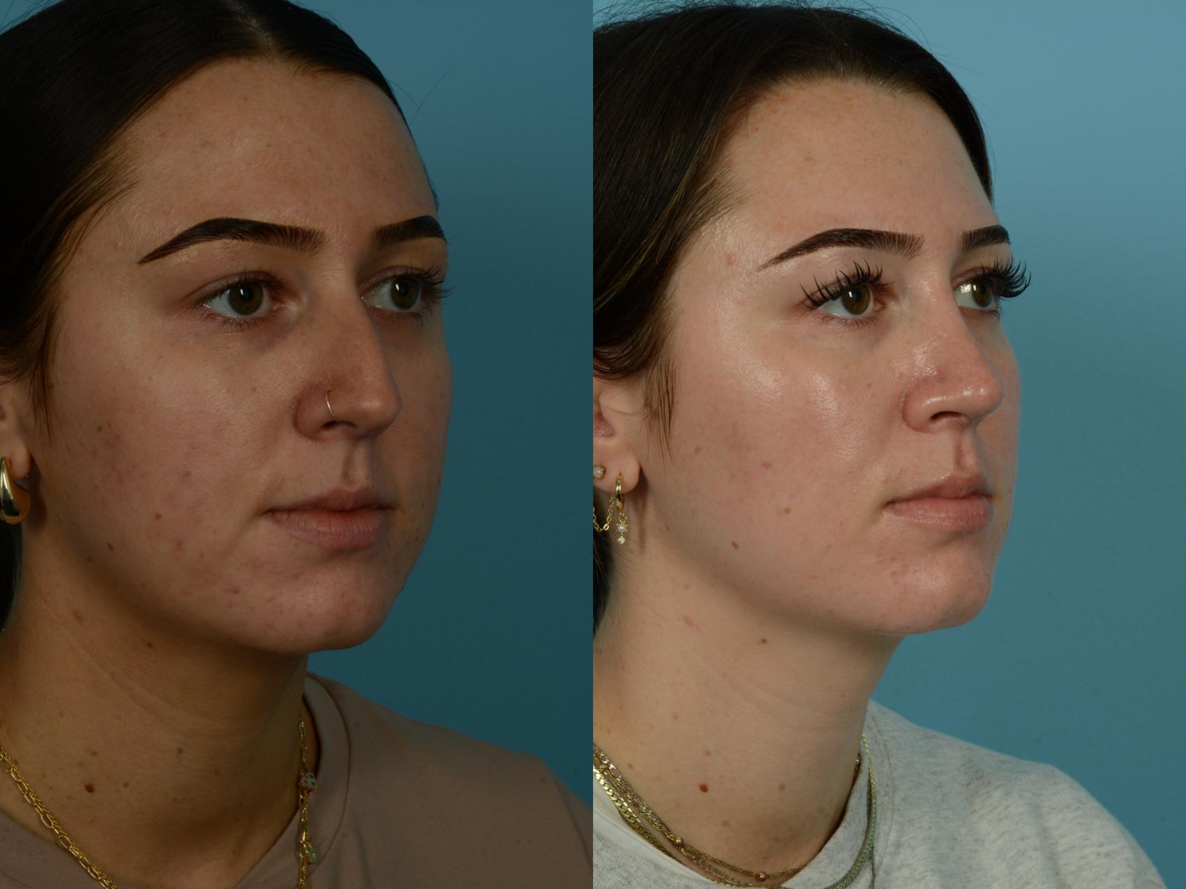 Before & After Rhinoplasty by Dr. Sinno Case 1147 Right Oblique View in Chicago, IL