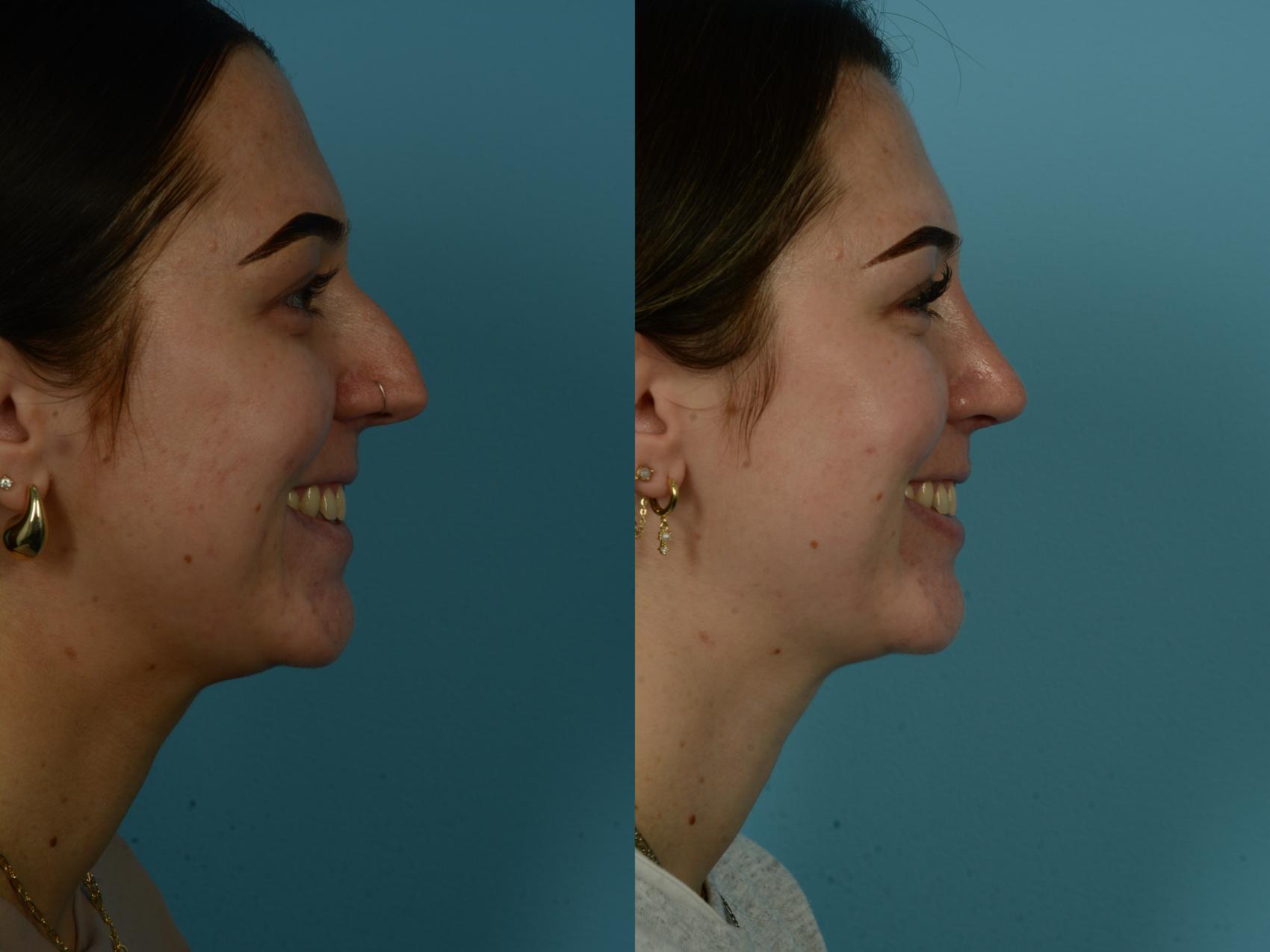 Before & After Rhinoplasty by Dr. Sinno Case 1147 Right Side View in Chicago, IL
