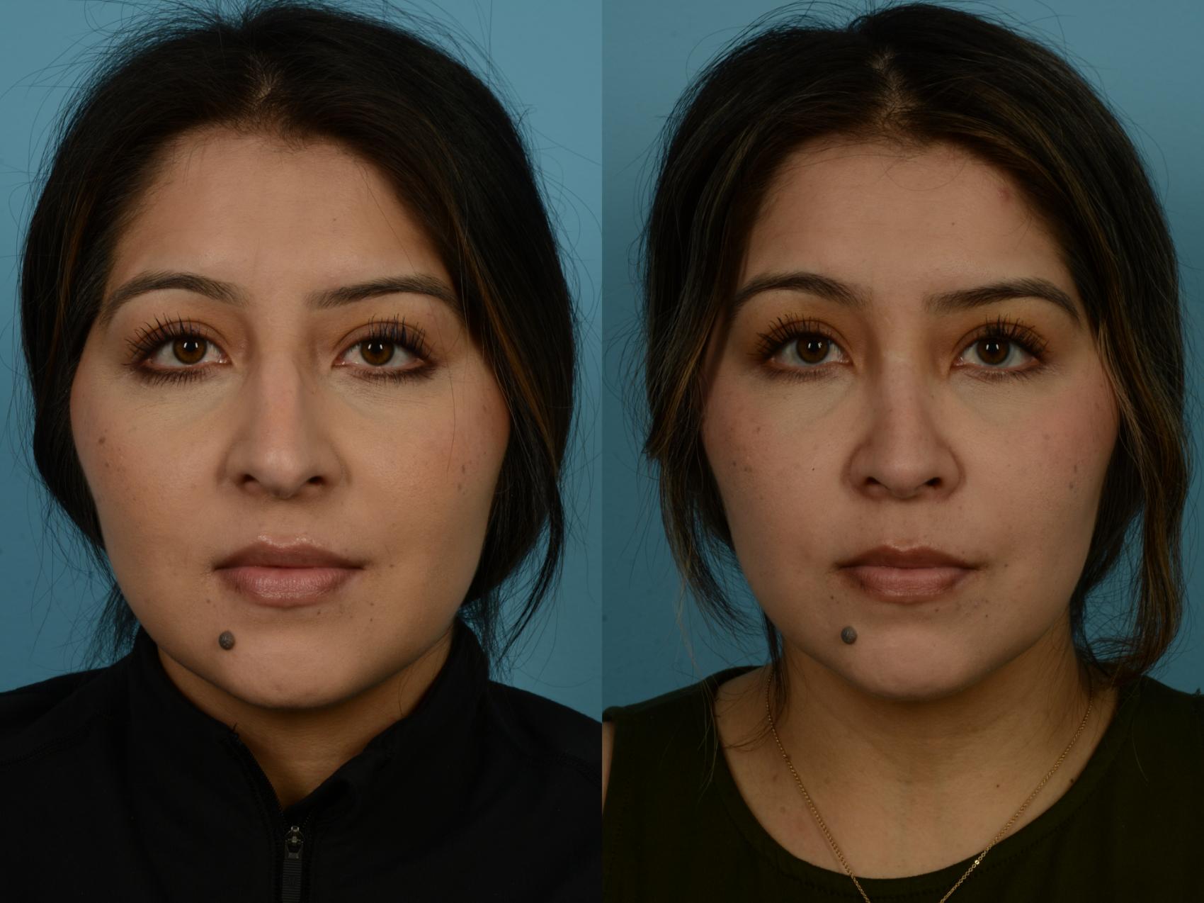 Before & After Rhinoplasty by Dr. Sinno Case 1148 Front View in Chicago, IL