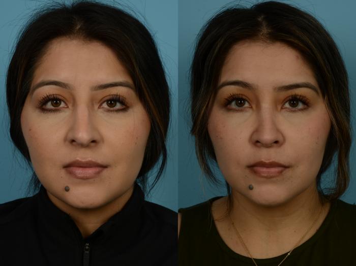Before & After Rhinoplasty by Dr. Sinno Case 1148 Front View in Chicago, IL