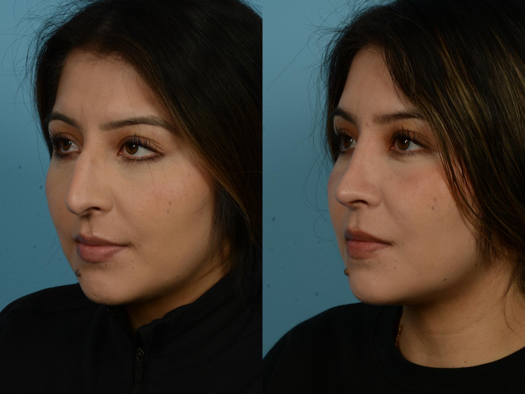 Before & After Rhinoplasty by Dr. Sinno Case 1148 Left Oblique View in Chicago, IL