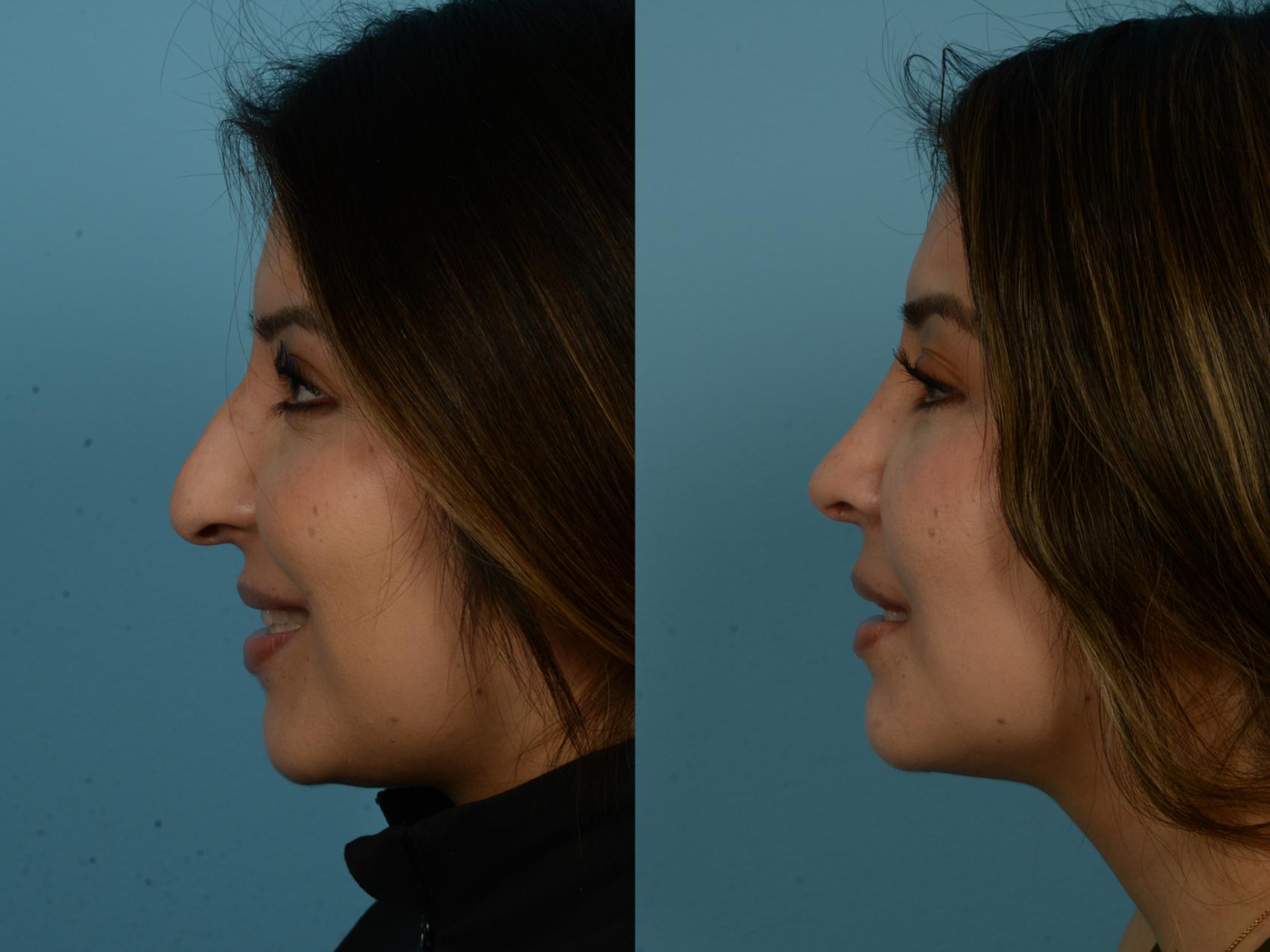 Before & After Rhinoplasty by Dr. Sinno Case 1148 Left Side View in Chicago, IL