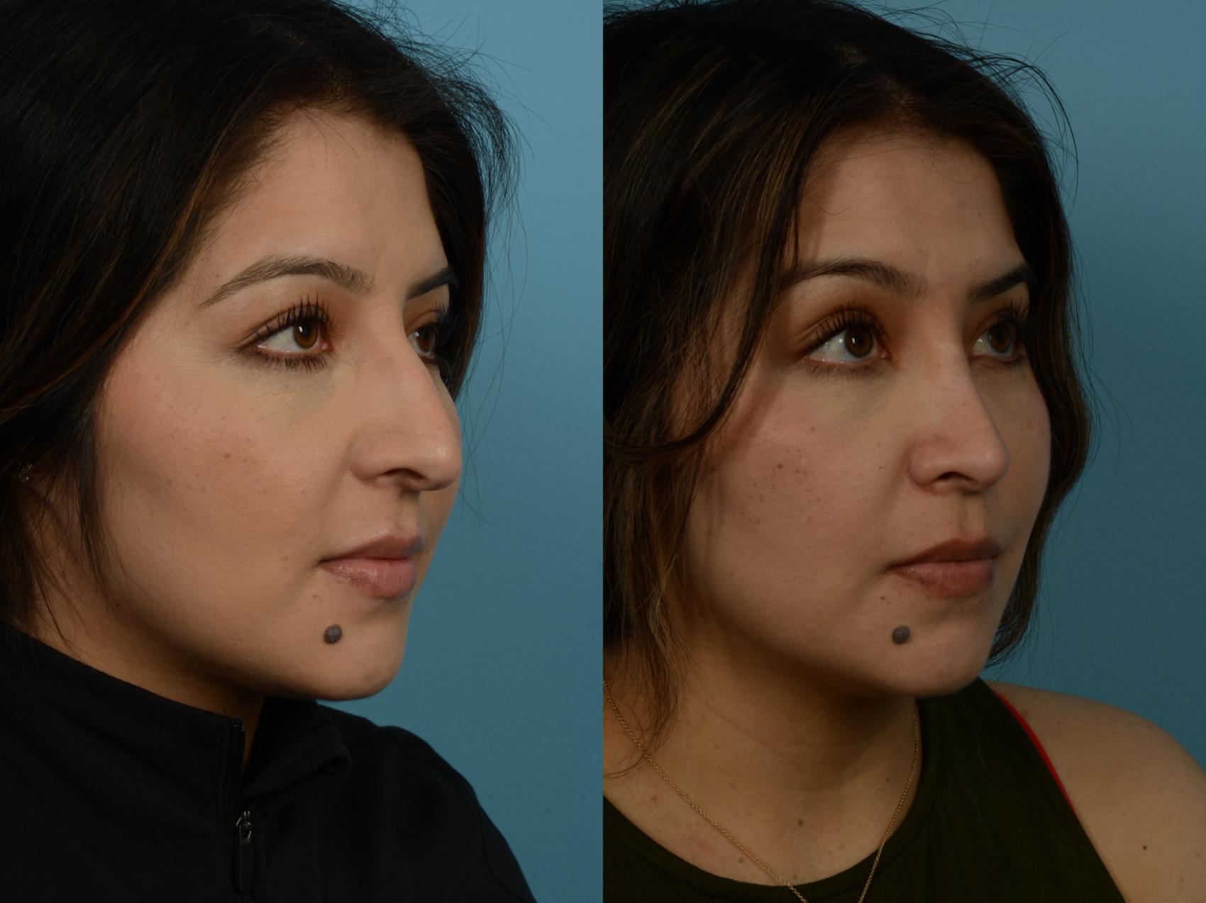 Before & After Rhinoplasty by Dr. Sinno Case 1148 Right Oblique View in Chicago, IL