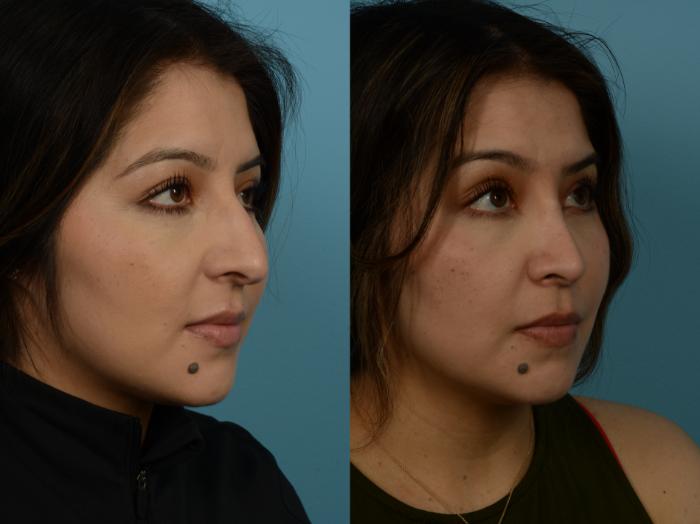 Before & After Rhinoplasty by Dr. Sinno Case 1148 Right Oblique View in Chicago, IL