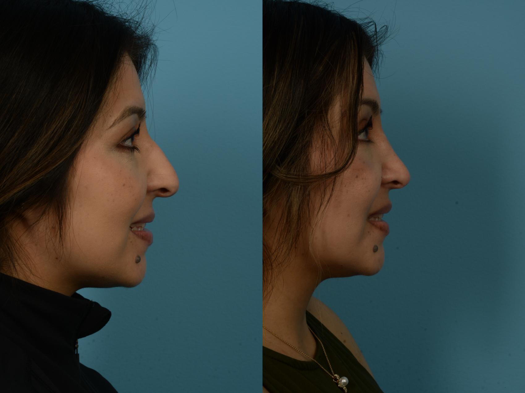 Before & After Rhinoplasty by Dr. Sinno Case 1148 Right Side View in Chicago, IL