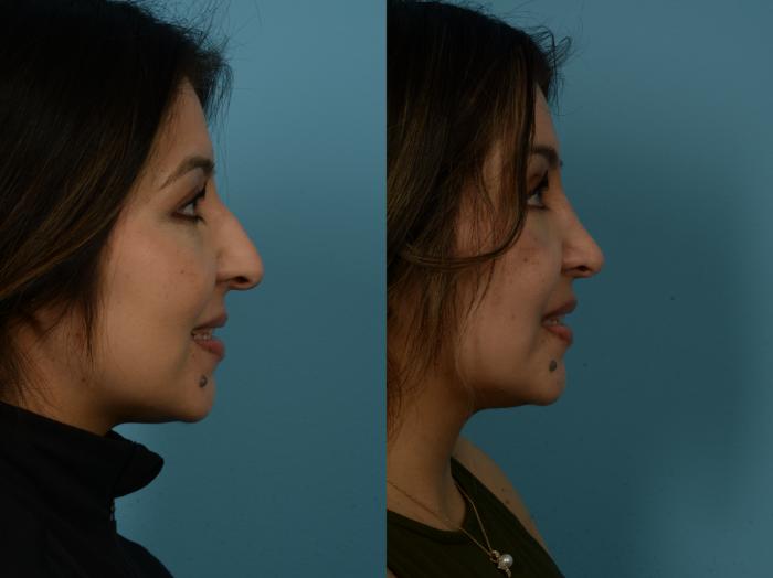 Before & After Rhinoplasty by Dr. Sinno Case 1148 Right Side View in Chicago, IL