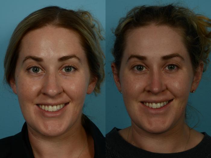 Before & After Rhinoplasty by Dr. Sinno Case 1150 Front View in Chicago, IL