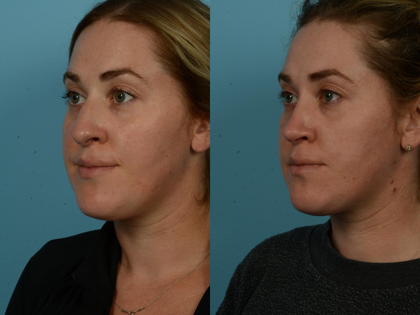 Before & After Rhinoplasty by Dr. Sinno Case 1150 Left Oblique View in Chicago, IL