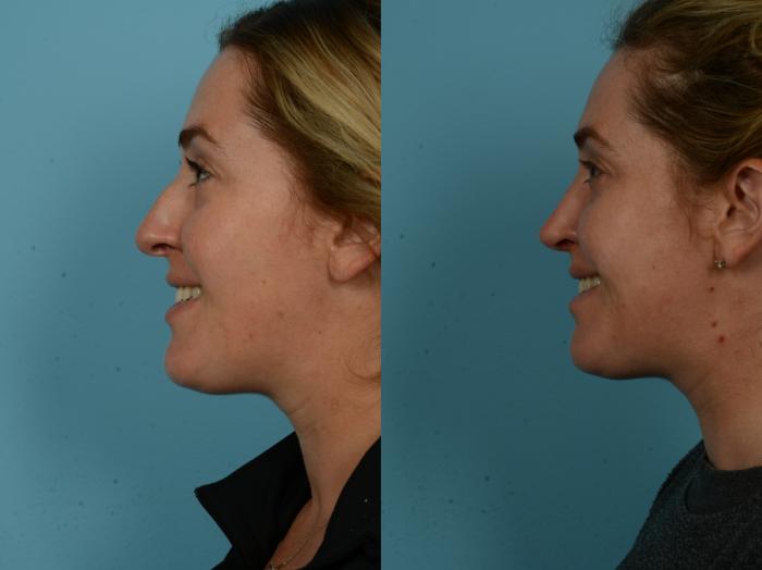Before & After Rhinoplasty by Dr. Sinno Case 1150 Left Side View in Chicago, IL