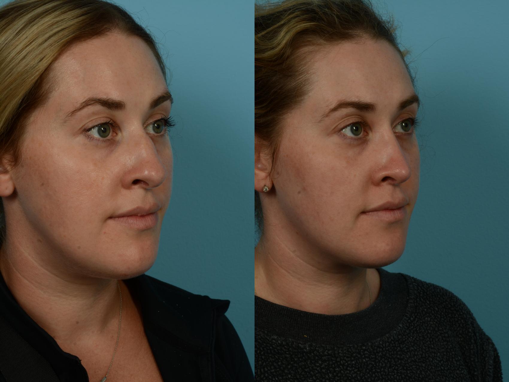 Before & After Rhinoplasty by Dr. Sinno Case 1150 Right Oblique View in Chicago, IL