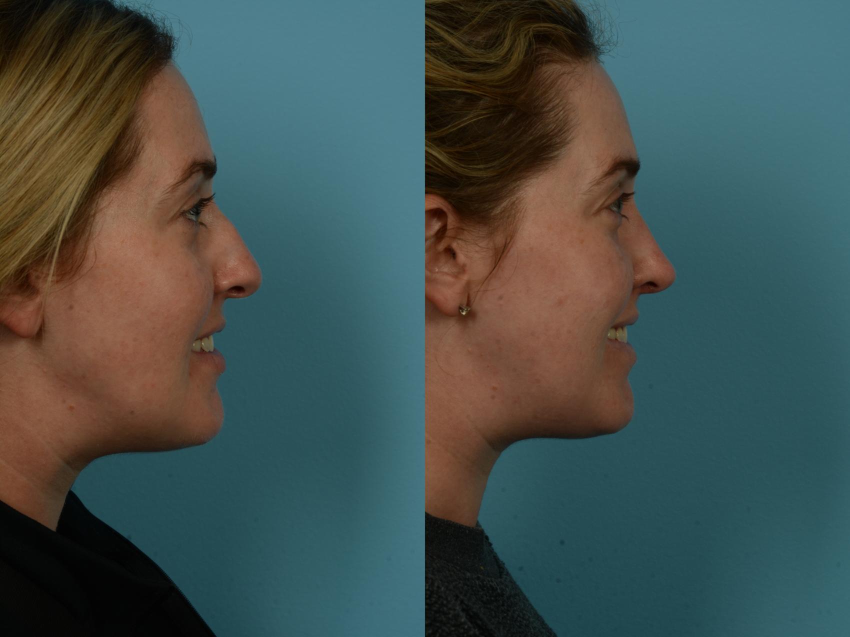 Before & After Rhinoplasty by Dr. Sinno Case 1150 Right Side View in Chicago, IL