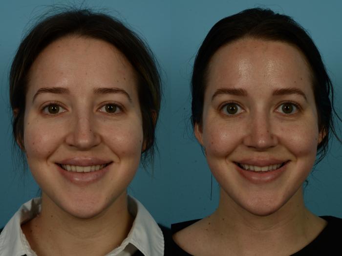 Before & After Rhinoplasty by Dr. Sinno Case 1151 Front View in Chicago, IL