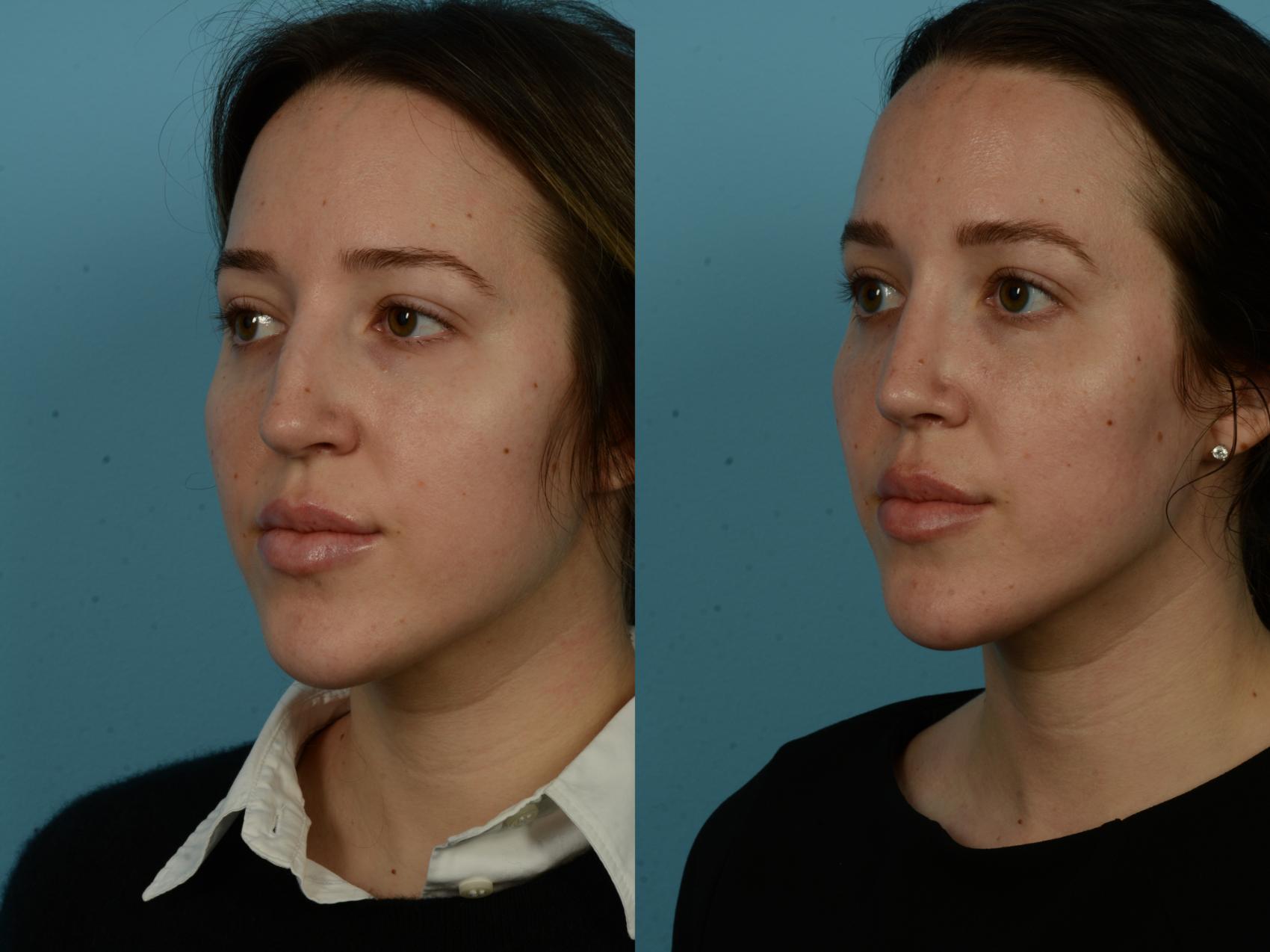 Before & After Rhinoplasty by Dr. Sinno Case 1151 Left Oblique View in Chicago, IL