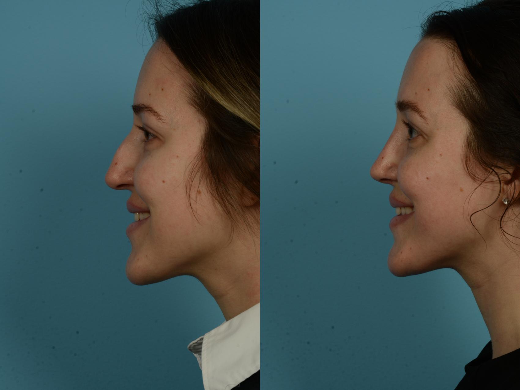 Before & After Rhinoplasty by Dr. Sinno Case 1151 Left Side View in Chicago, IL