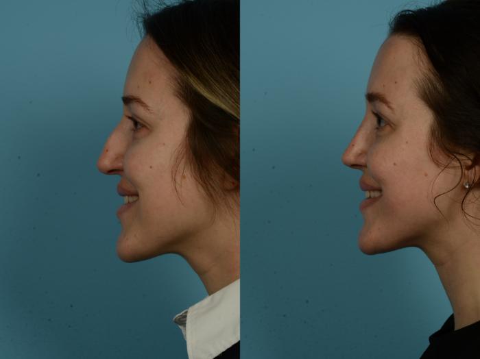 Before & After Rhinoplasty by Dr. Sinno Case 1151 Left Side View in Chicago, IL