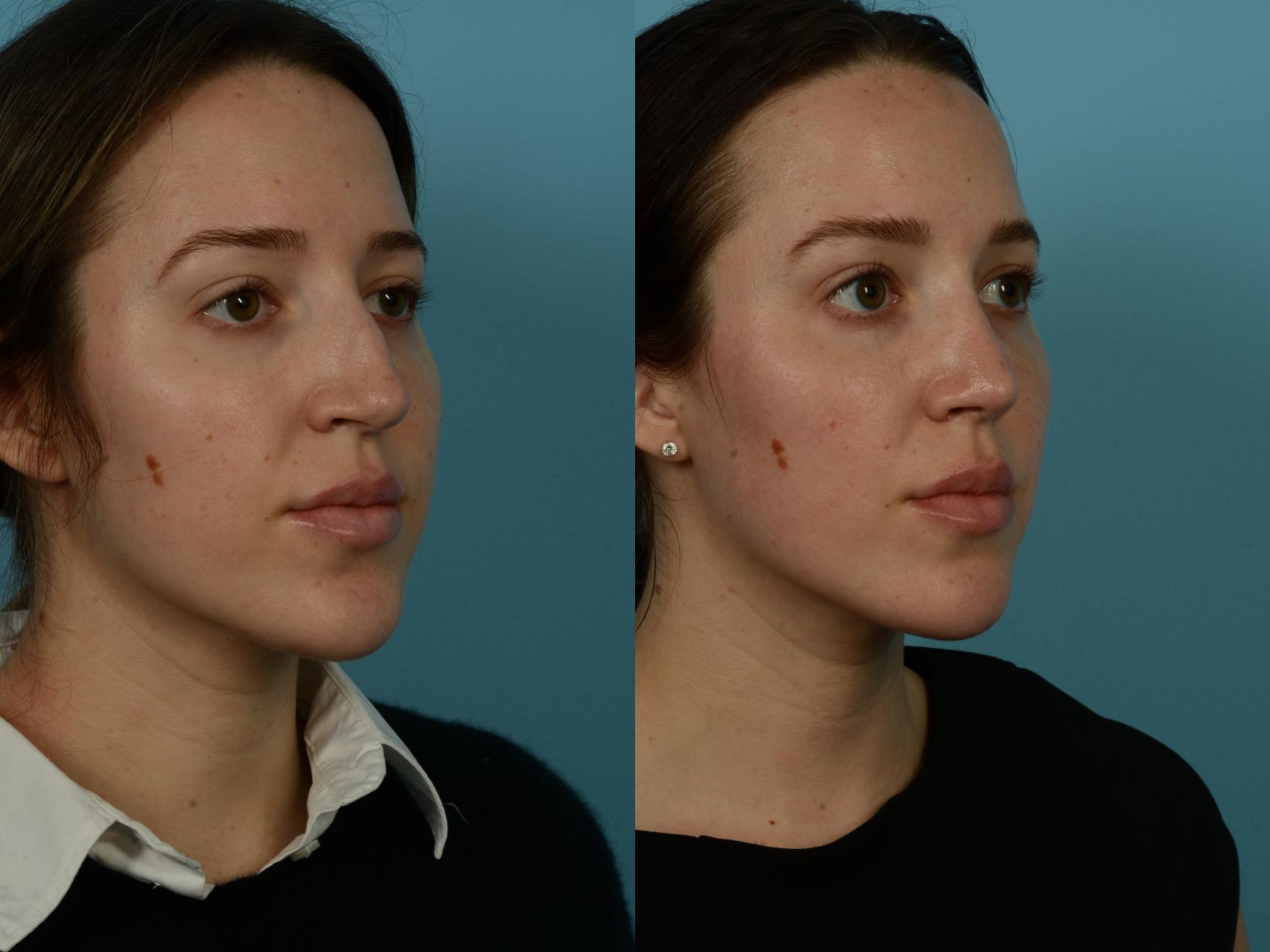 Before & After Rhinoplasty by Dr. Sinno Case 1151 Right Oblique View in Chicago, IL