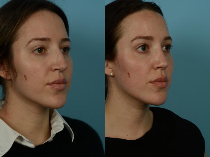 Before & After Rhinoplasty by Dr. Sinno Case 1151 Right Oblique View in Chicago, IL