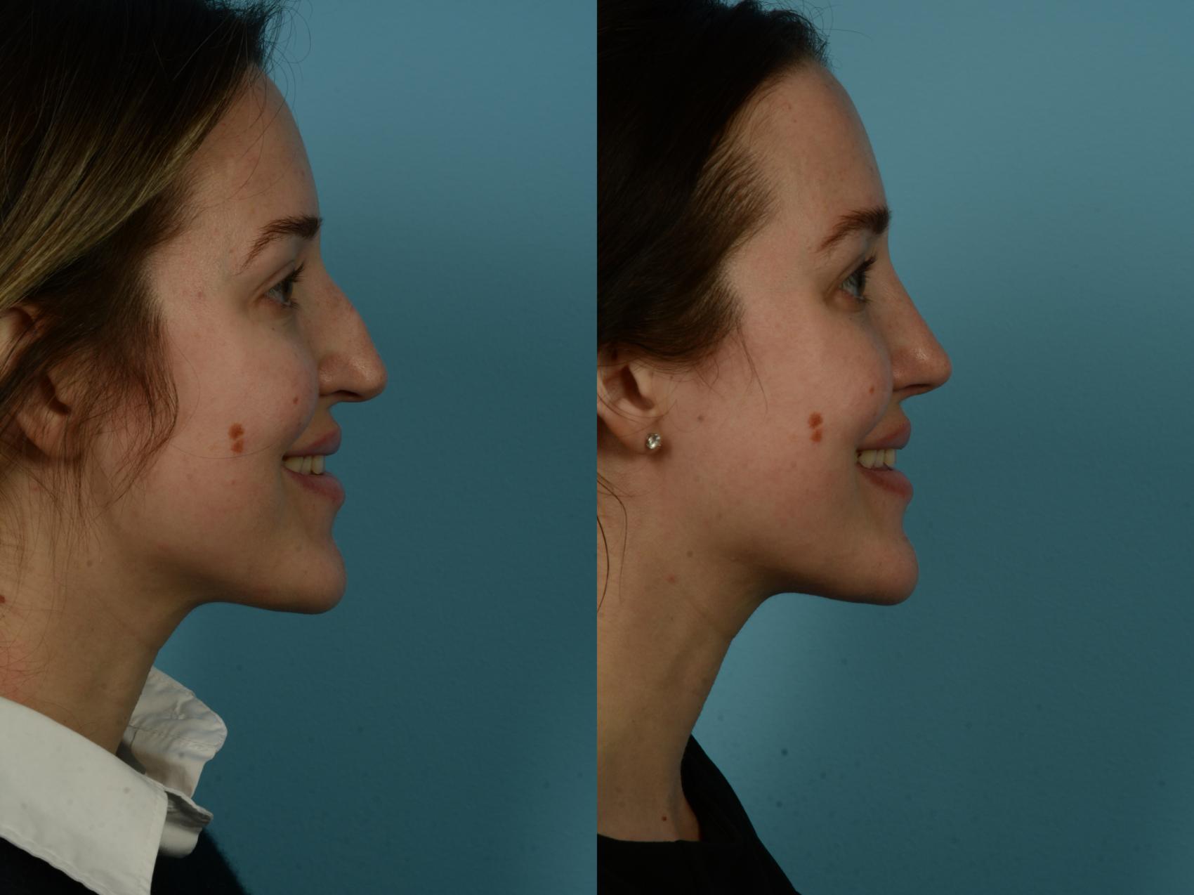 Before & After Rhinoplasty by Dr. Sinno Case 1151 Right Side View in Chicago, IL