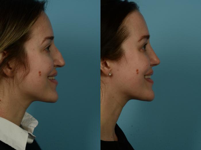 Before & After Rhinoplasty by Dr. Sinno Case 1151 Right Side View in Chicago, IL