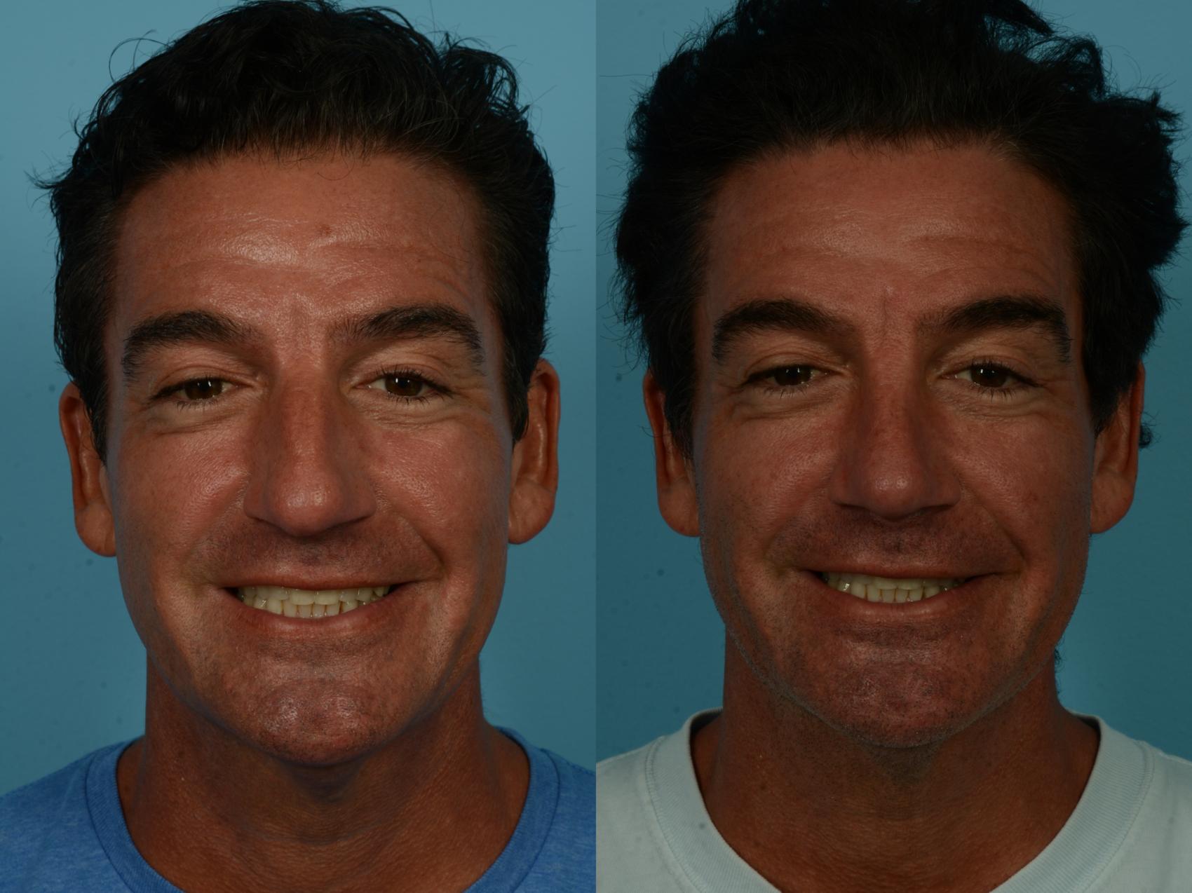 Before & After Rhinoplasty by Dr. Sinno Case 1152 Front View in Chicago, IL