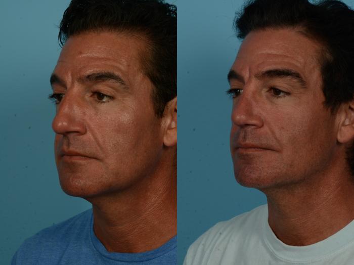 Before & After Rhinoplasty by Dr. Sinno Case 1152 Left Oblique View in Chicago, IL