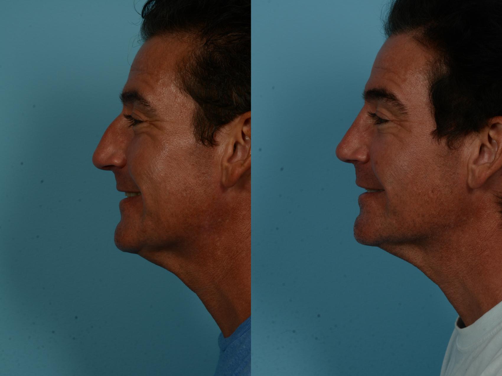 Before & After Rhinoplasty by Dr. Sinno Case 1152 Left Side View in Chicago, IL