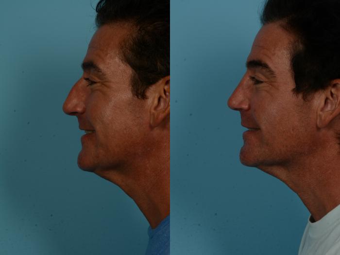 Before & After Rhinoplasty by Dr. Sinno Case 1152 Left Side View in Chicago, IL