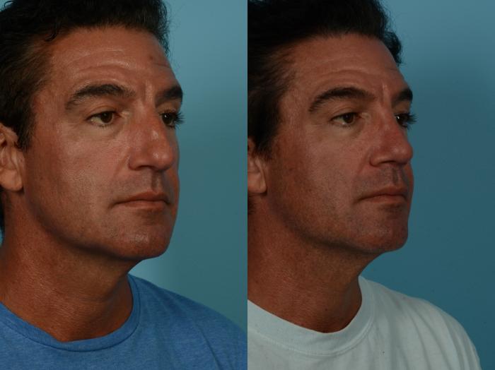 Before & After Rhinoplasty by Dr. Sinno Case 1152 Right Oblique View in Chicago, IL