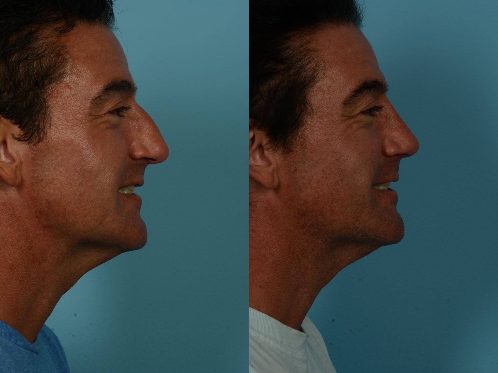 Before & After Rhinoplasty by Dr. Sinno Case 1152 Right Side View in Chicago, IL