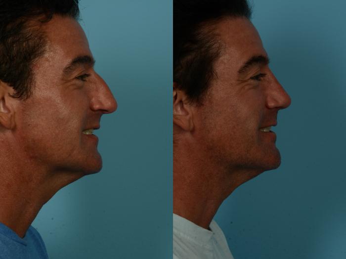Before & After Rhinoplasty by Dr. Sinno Case 1152 Right Side View in Chicago, IL