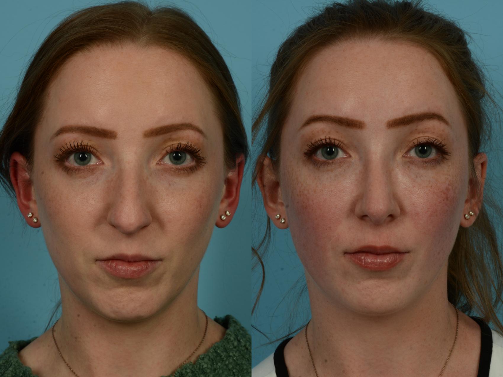 Before & After Rhinoplasty by Dr. Sinno Case 1153 Front View in Chicago, IL