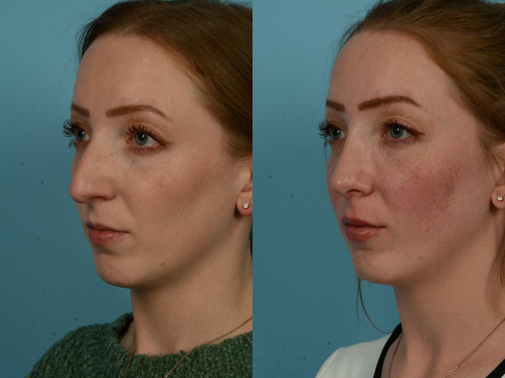 Before & After Rhinoplasty by Dr. Sinno Case 1153 Left Oblique View in Chicago, IL