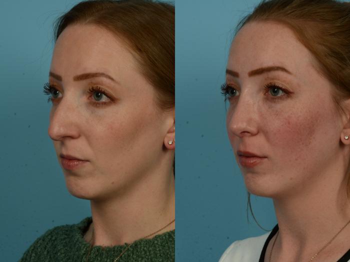 Before & After Rhinoplasty by Dr. Sinno Case 1153 Left Oblique View in Chicago, IL