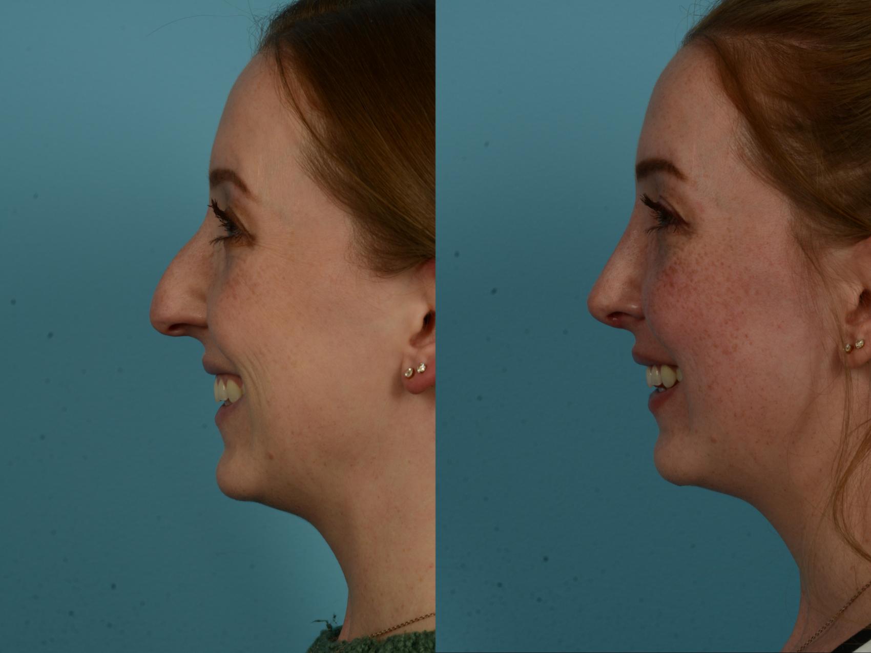 Before & After Rhinoplasty by Dr. Sinno Case 1153 Left Side View in Chicago, IL