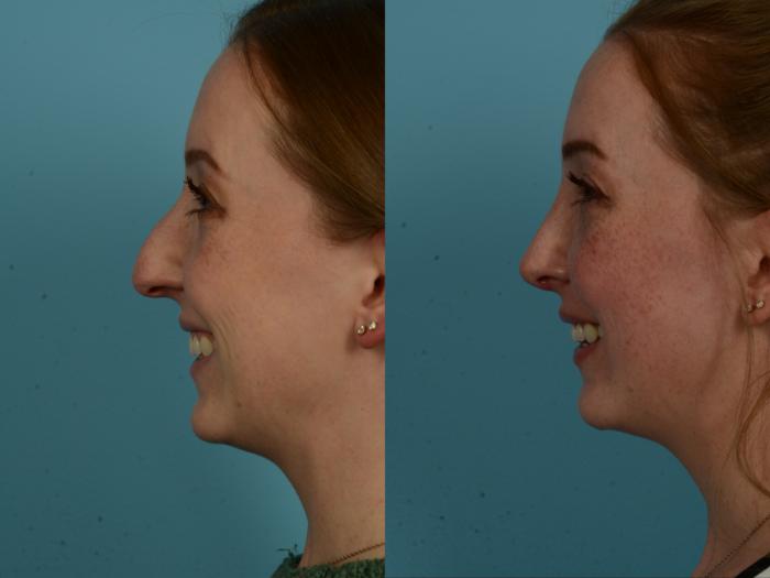Before & After Rhinoplasty by Dr. Sinno Case 1153 Left Side View in Chicago, IL
